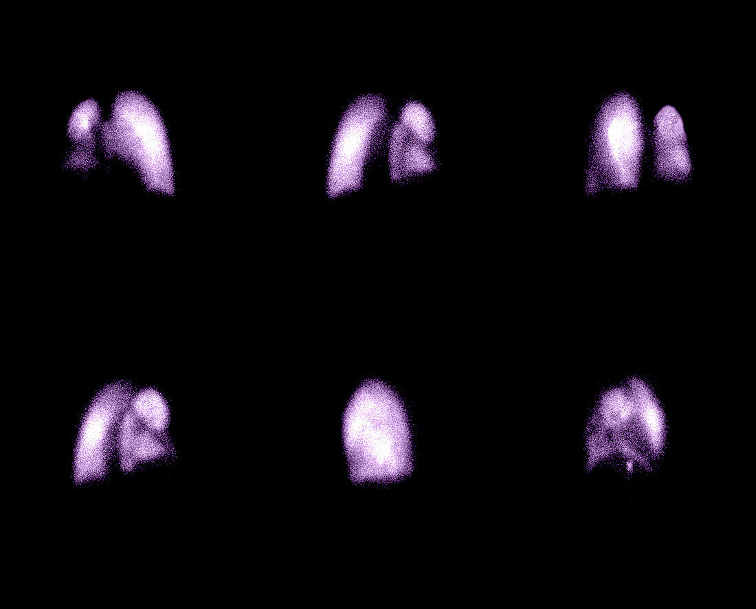 Nuclear Medicine Lung Scan