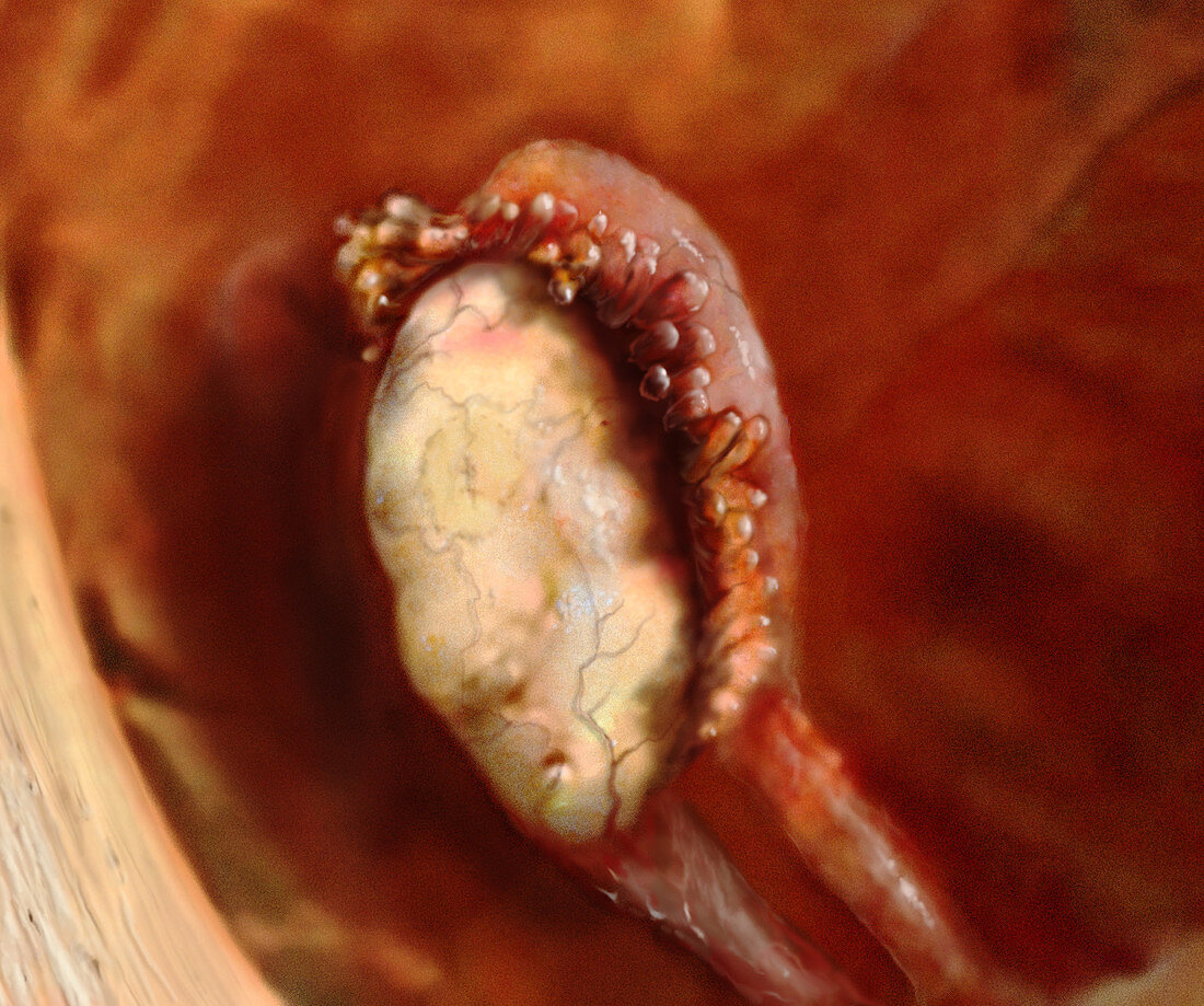 Ovary and Fallopian Tube