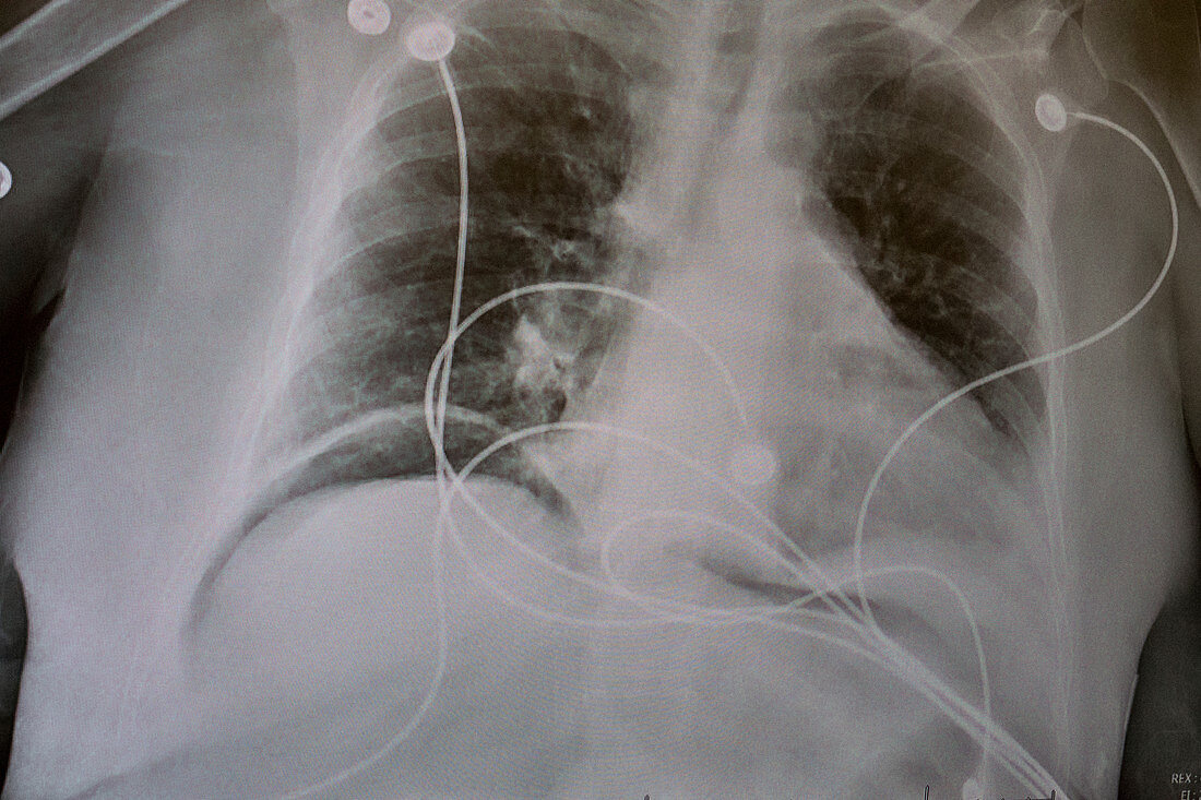 Pneumoperitoneum,X-ray