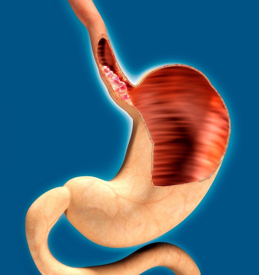 Oesophageal cancer,illustration