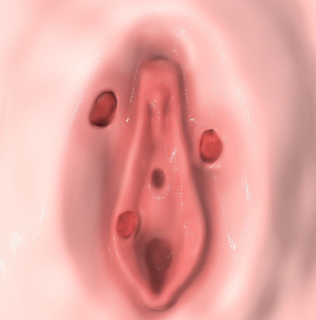 Female syphilis,illustration