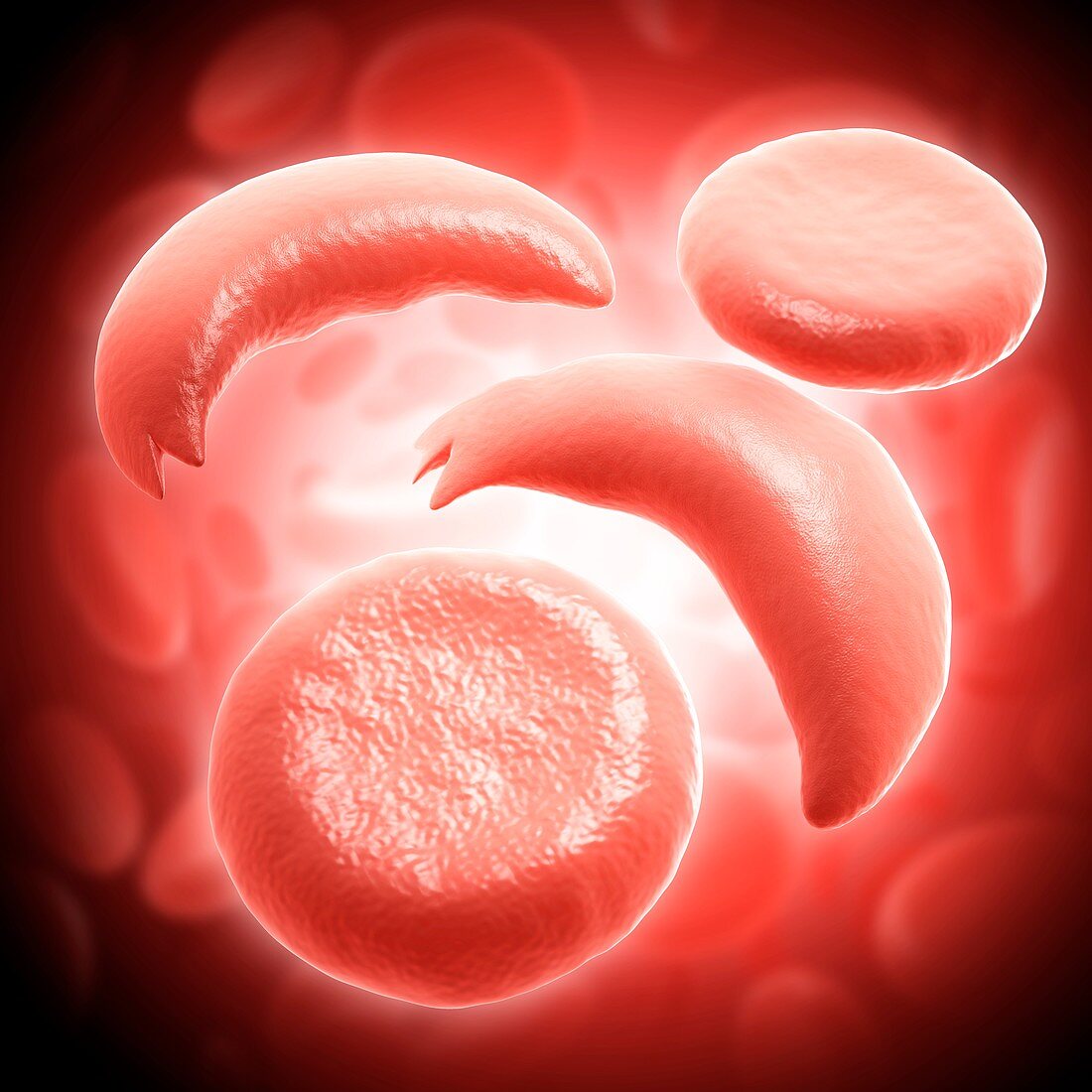 Red blood cells in sickle cell anaemia