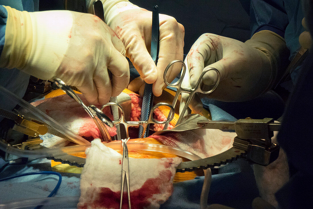 Kidney transplant surgery
