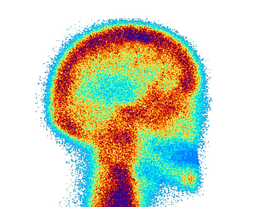 Bone scintigraphy of human head