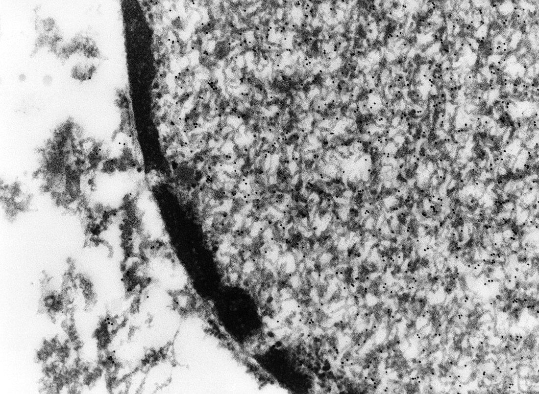 TEM of brain cell nucleus in measles encephalitis