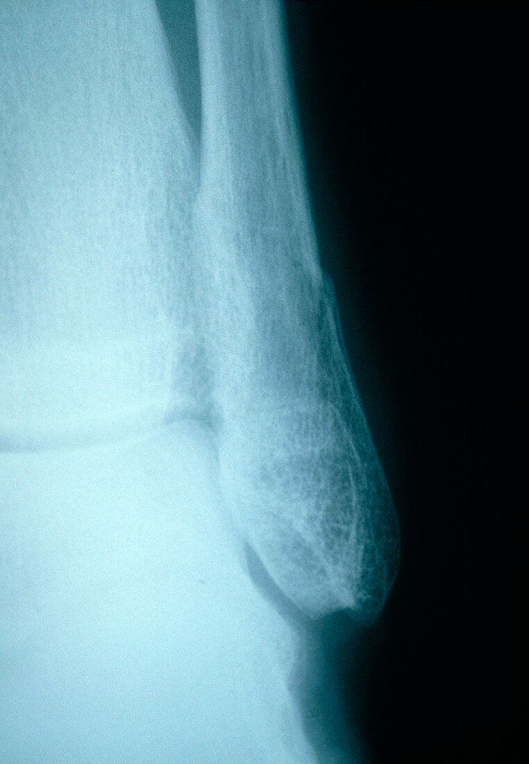 X-ray of an elderly woman's fractured fibula bone
