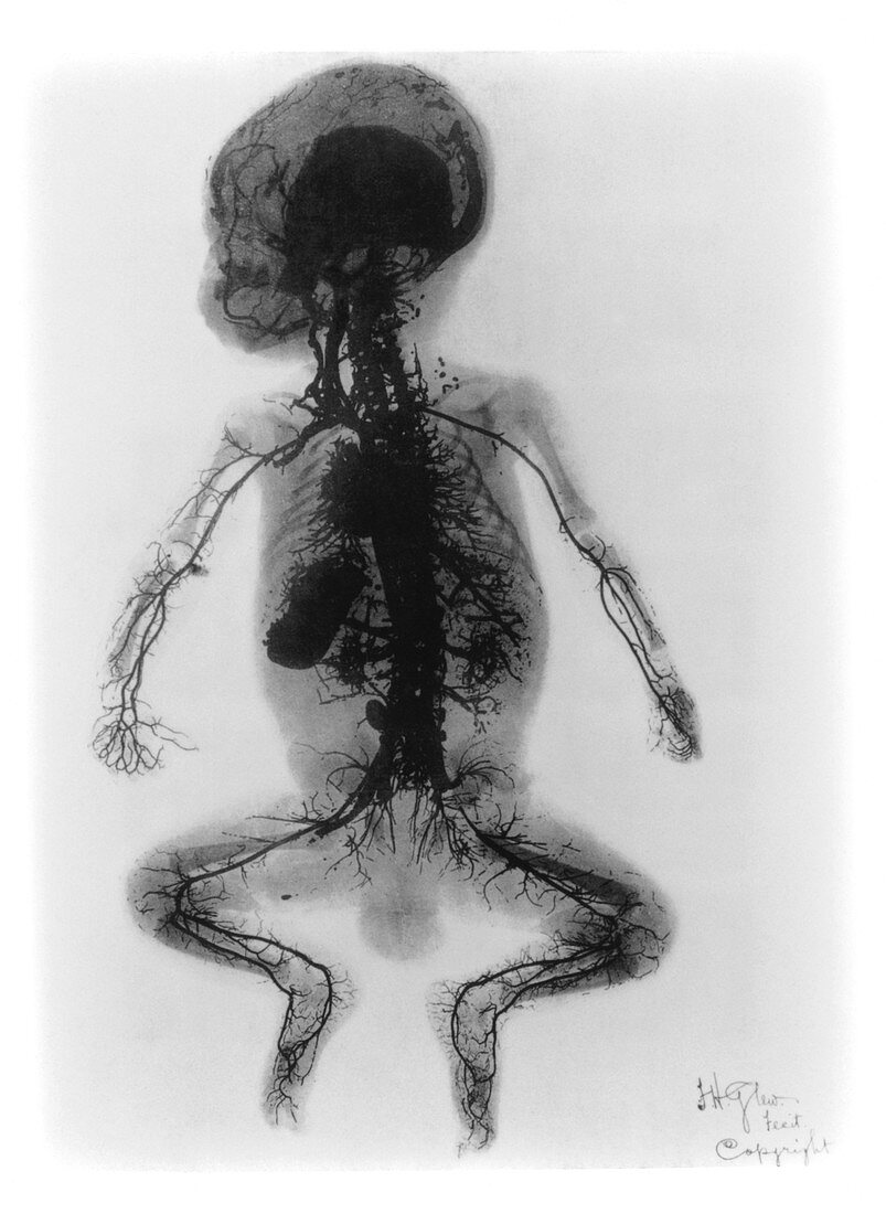 Early X-ray arteriogram of injected child,1899