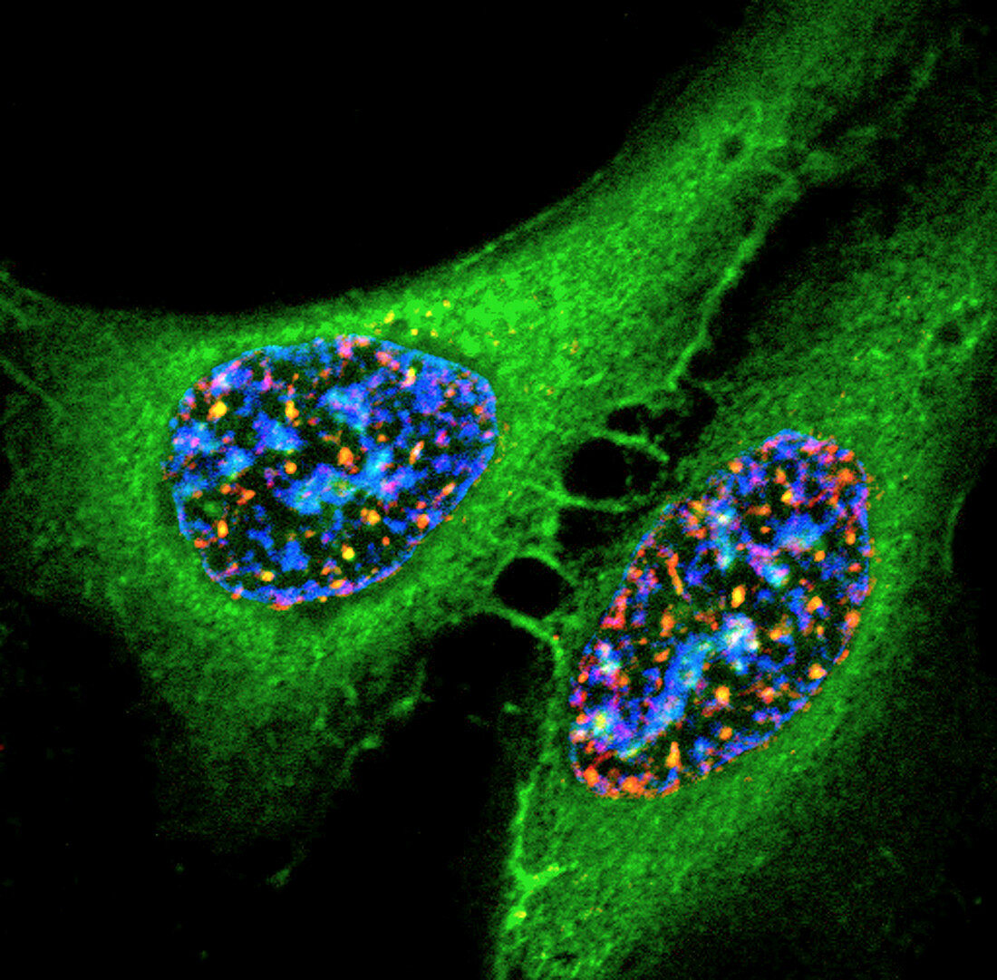 Osteosarcoma cells, light micrograph