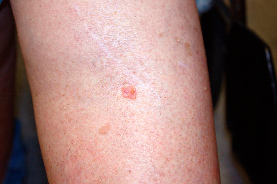 Squamous cell carcinoma on a leg