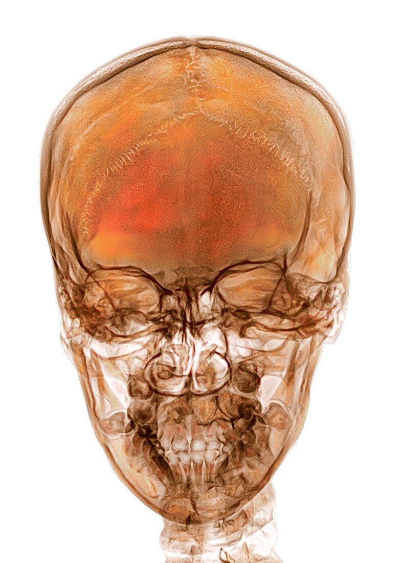 Human skull, frontal X-ray