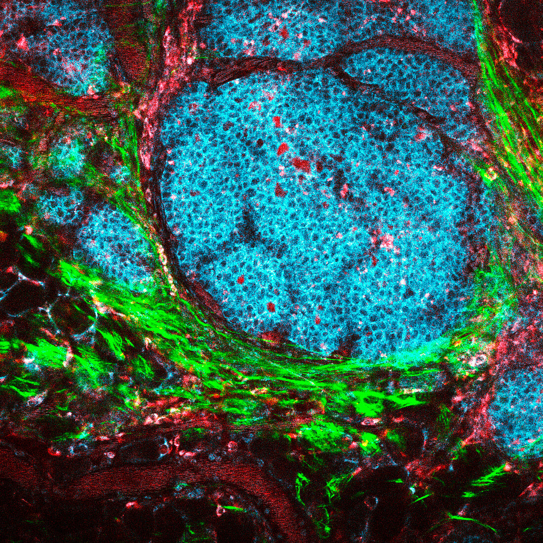 Breast cancer, multiphoton micrograph