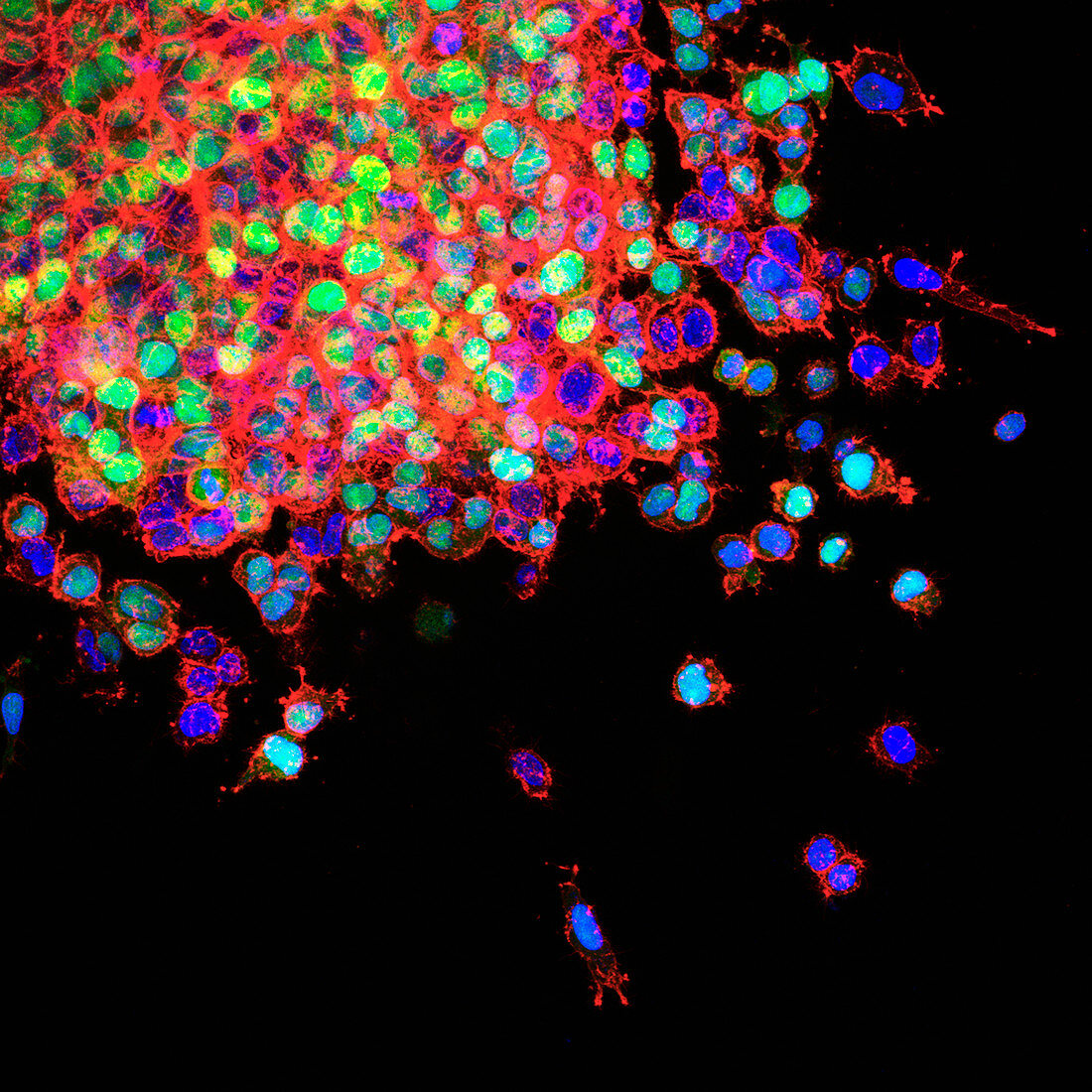 Lung cancer metastasis, light micrograph