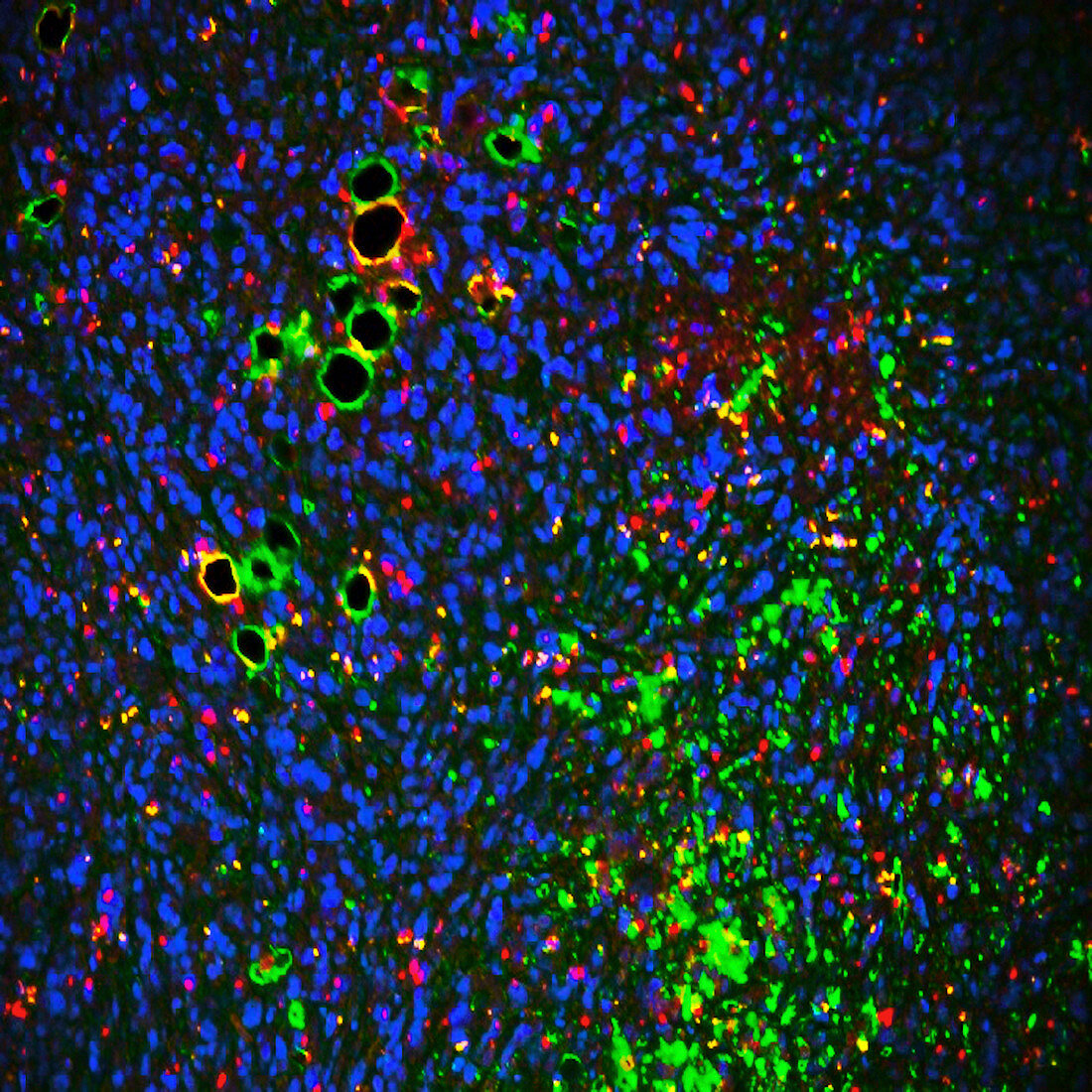 Breast tumour microenvironment