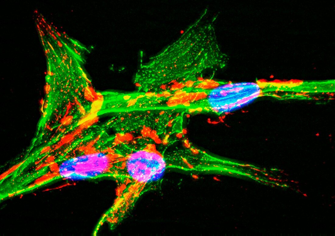 Astrocyte brain cells, fluorescence light micrograph