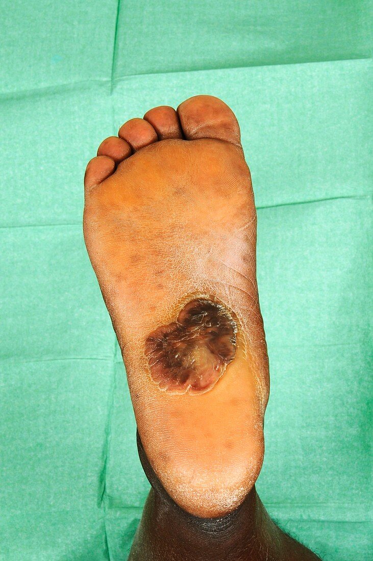 Keloid on the sole of the foot