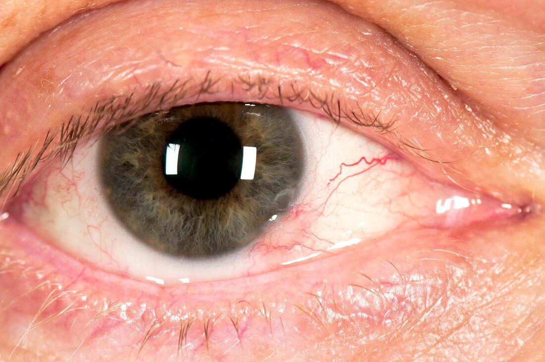 Phlyctenule in patient's eye