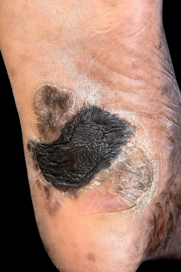 Keloid on the sole of the foot