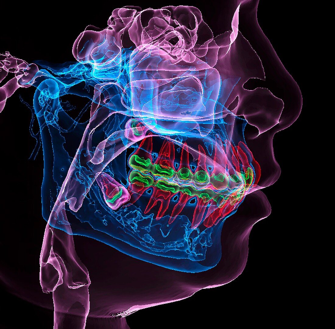 Impacted molar teeth, 3D CT scan