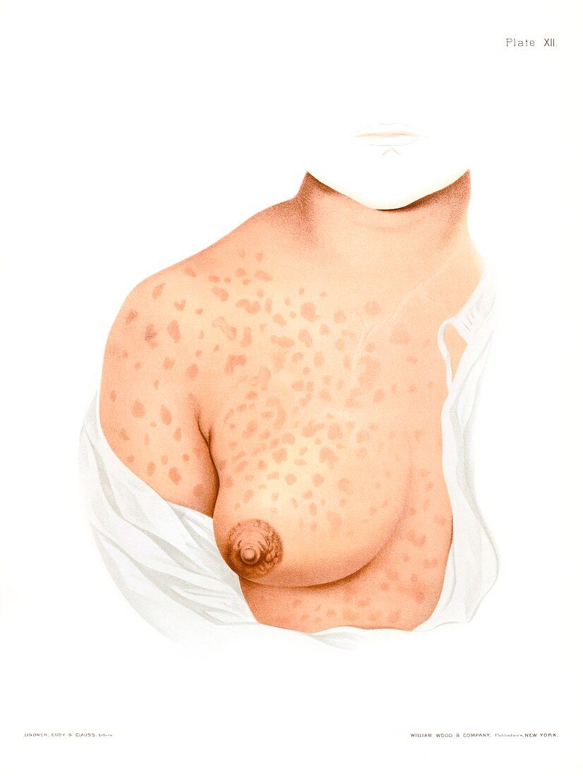 Syphilis rash on breast, illustration