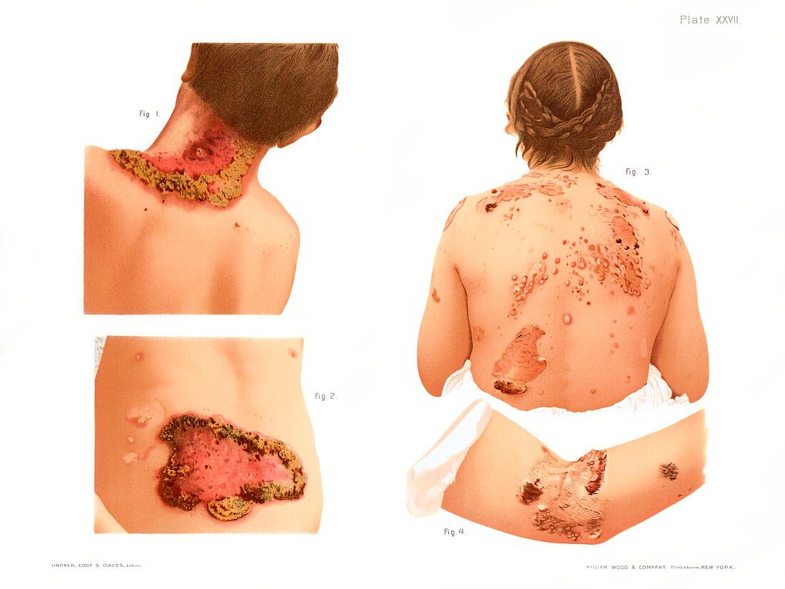 Secondary syphilis rash, illustration