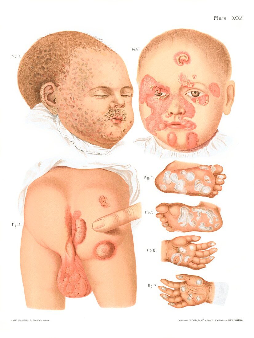 Congenital syphilis, illustration