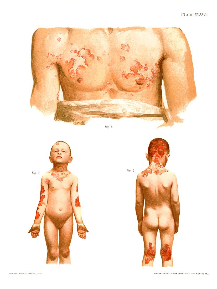 Seborrhoeic eczema, historical illustration