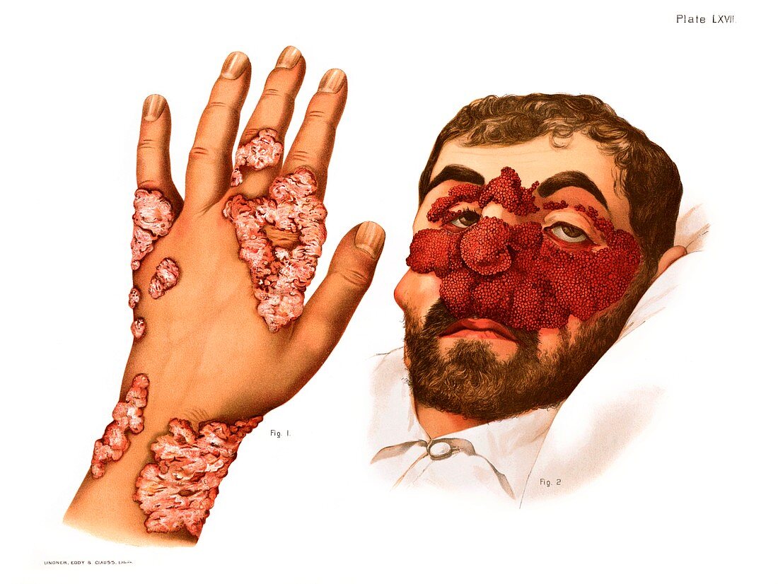 Cutaneous tuberculosis, illustration
