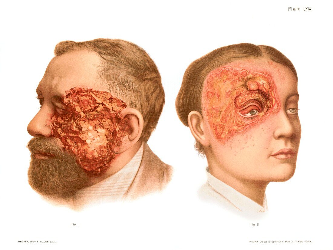 Epithelioma and rodent ulcer, illustration