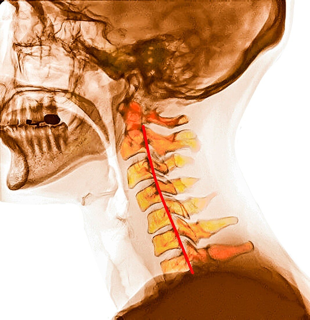 Straightened neck curvature, X-ray