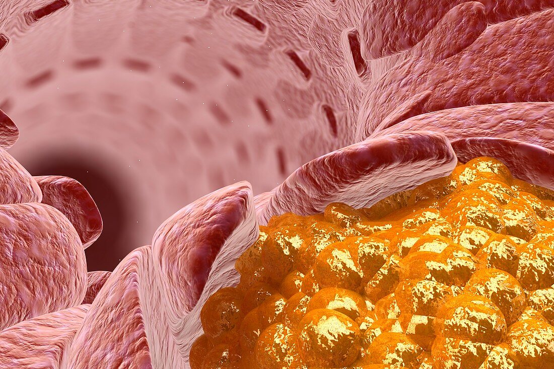 Cholesterol in a blood vessel, illustration