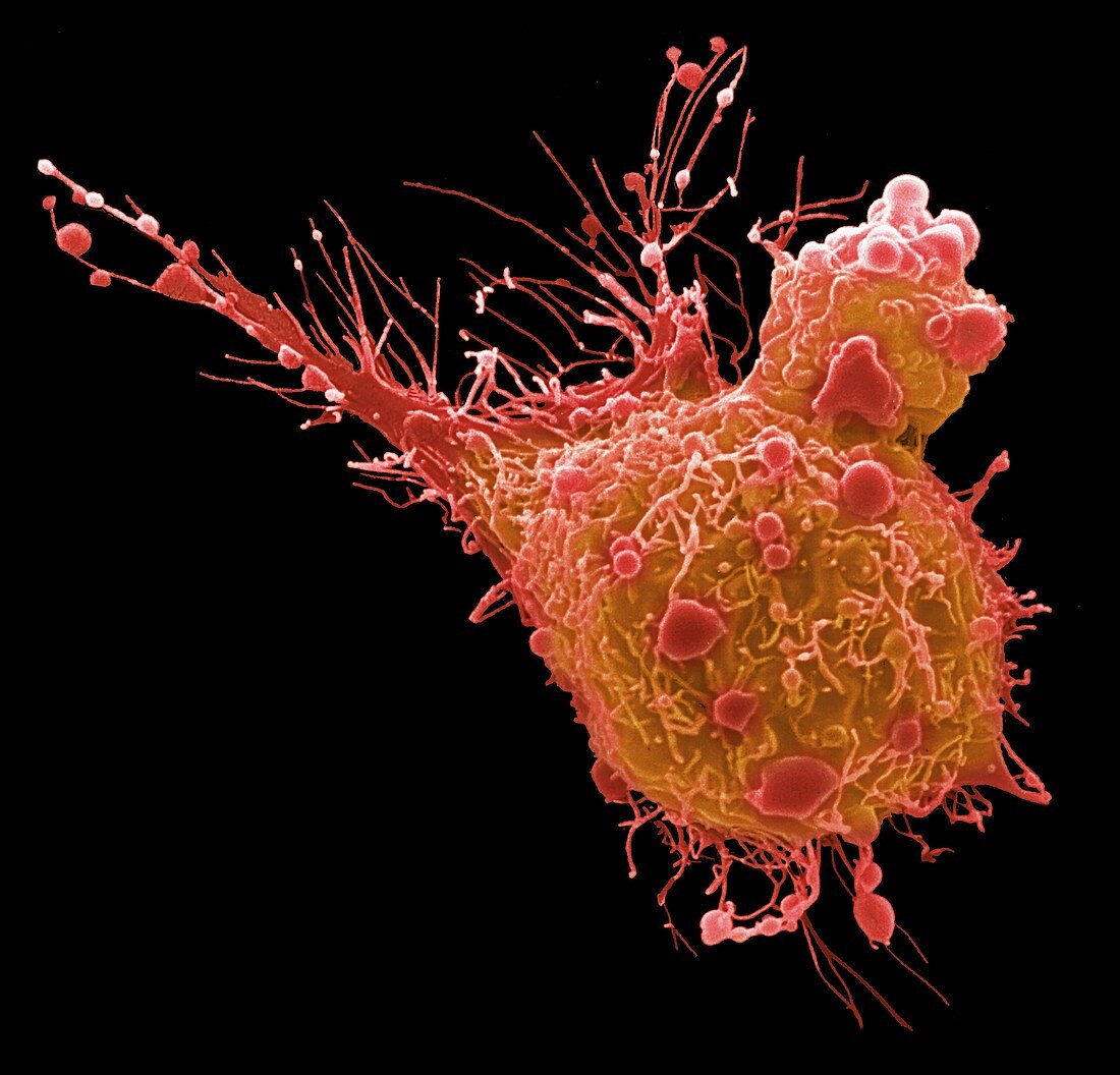 Bladder cancer cell, SEM
