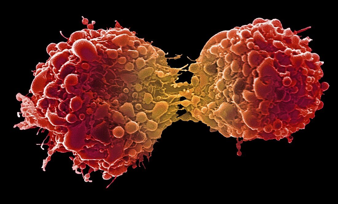 Dividing bladder cancer cells, SEM