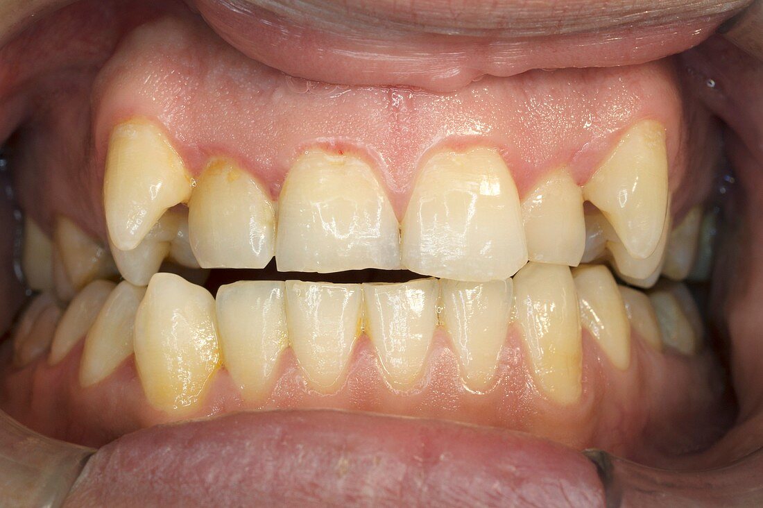 Patient with an open bite and irregular erupting teeth