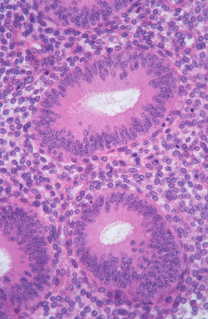 Normal endometrium cells