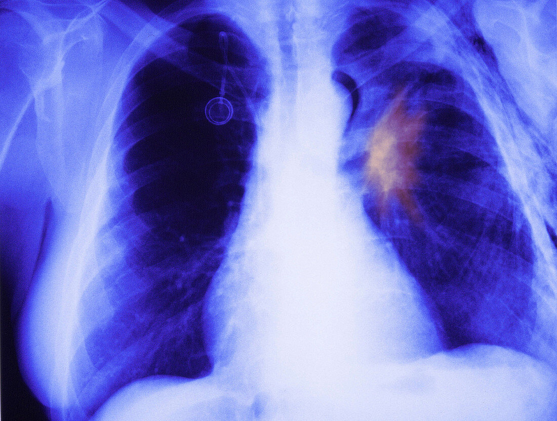 Emphysema, x-ray