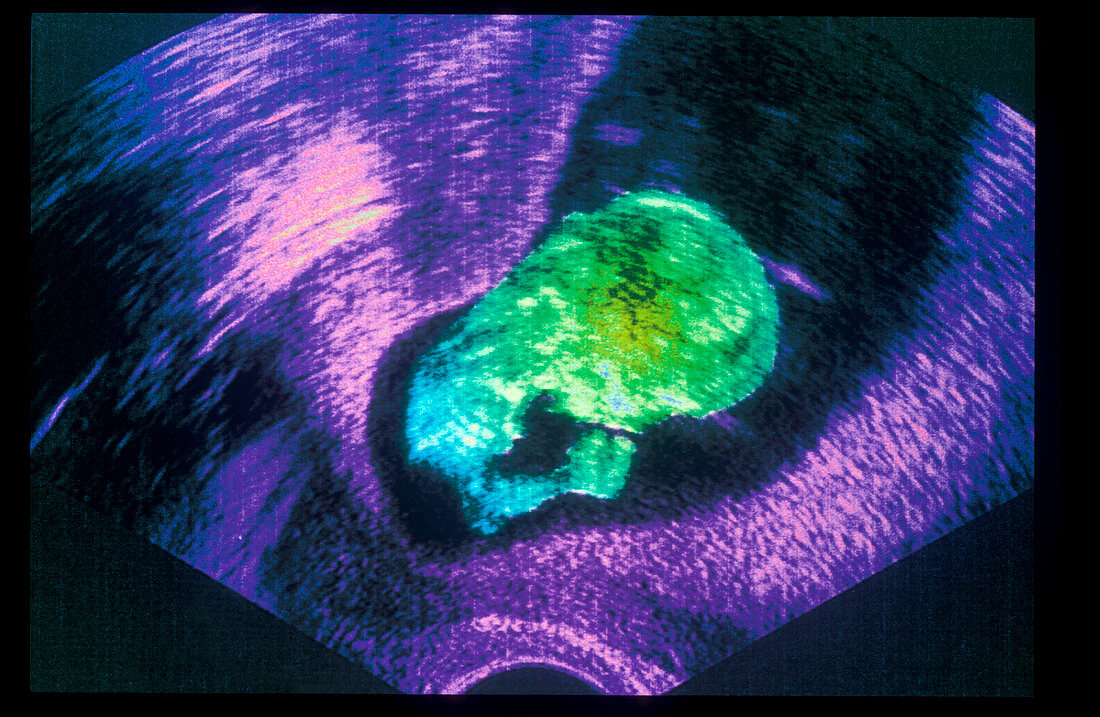 Ultrasound scan of a 3 month old foetus