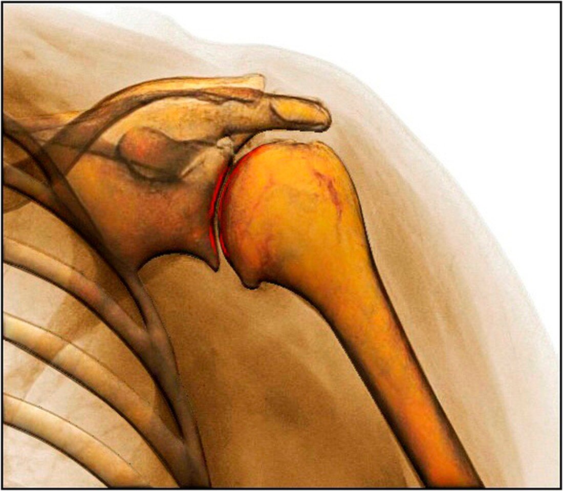 Shoulder joint degeneration, X-ray
