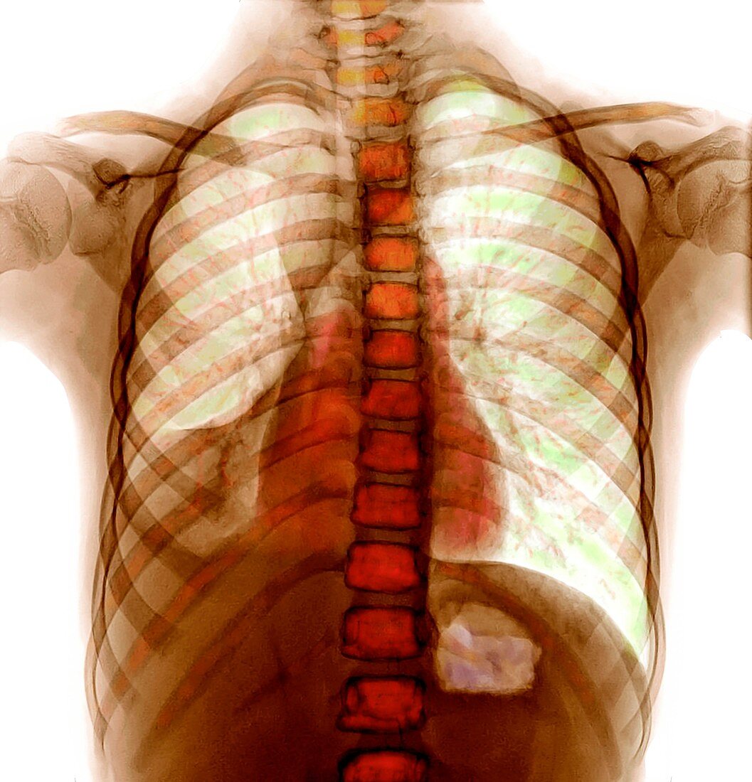 Pneumonia, chest X-ray