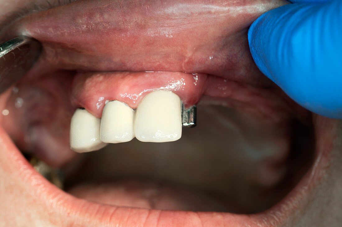 Dental bridge denture attachment