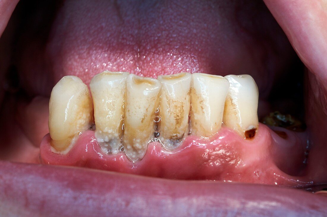 Gum disease caused by plaque