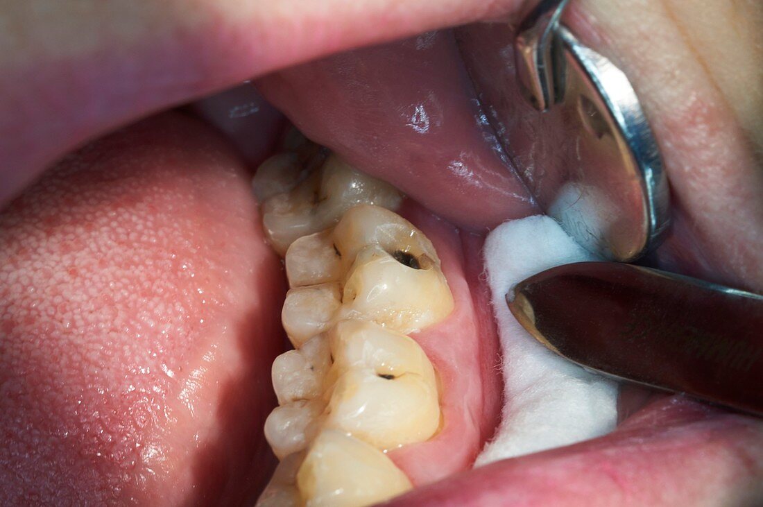 Dental caries in a molar