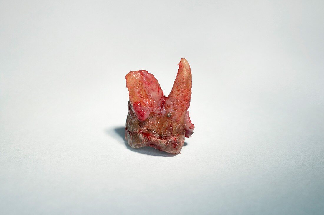 Extracted wisdom tooth