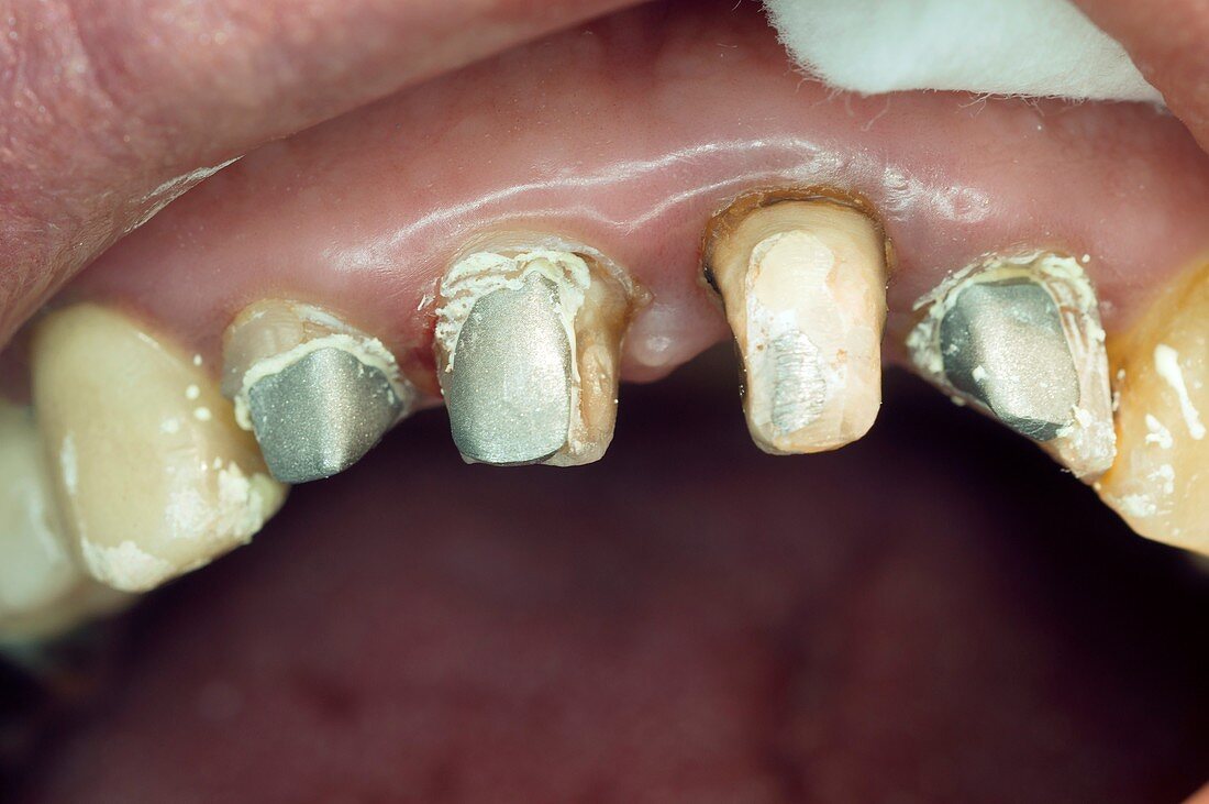 Teeth prepared for dental crowns