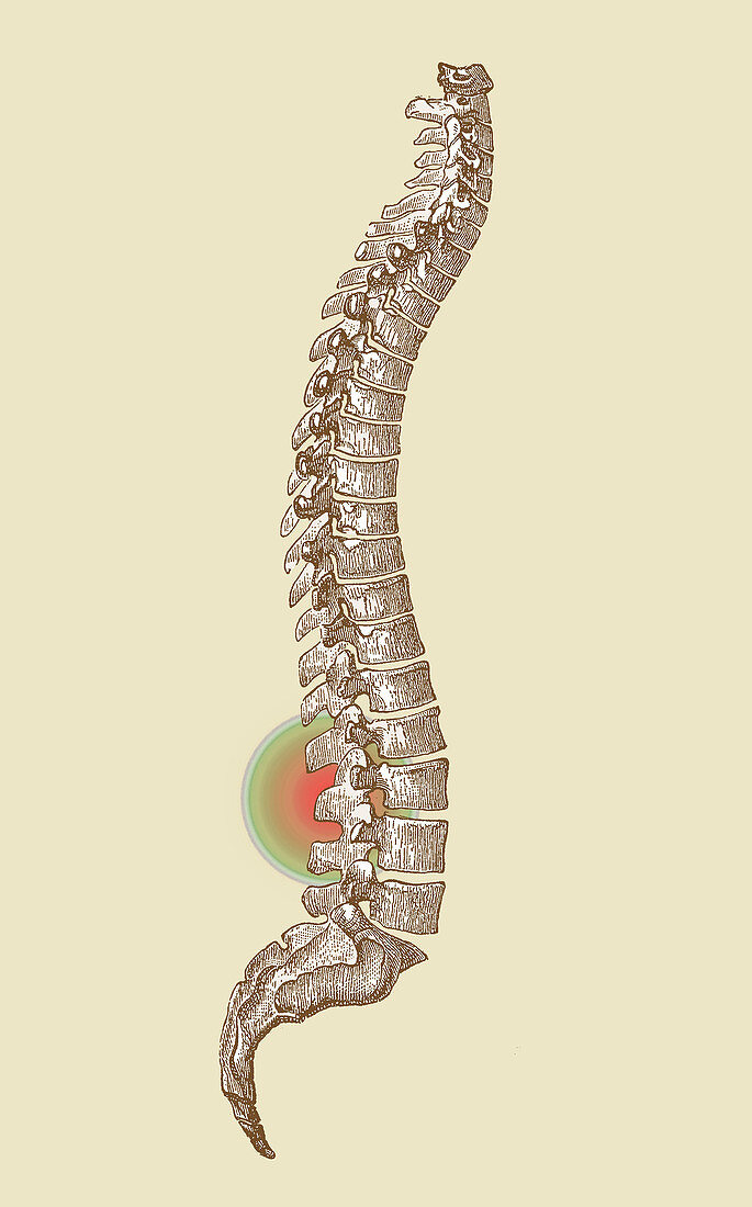 Lower Back Pain