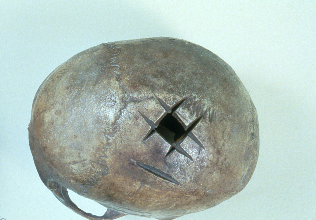 Ancient Peruvian Skull Surgery