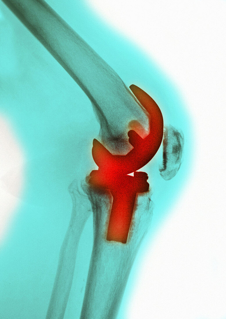 'Knee Replacement,X-ray'