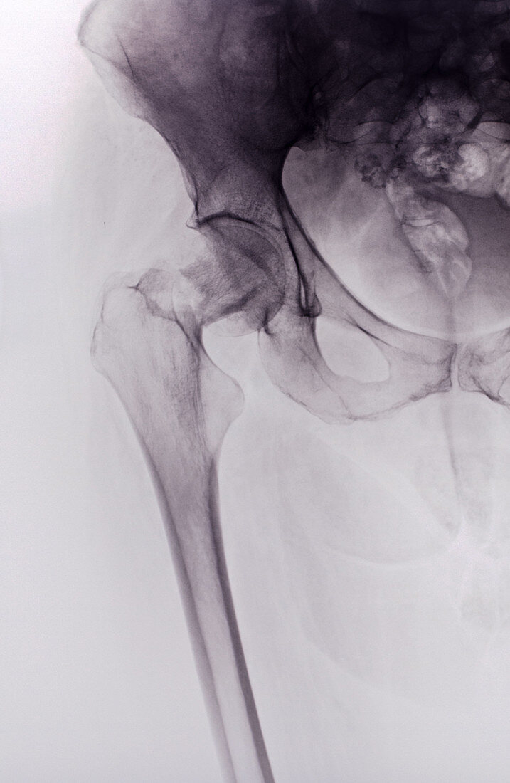 Hip Fracture X-Ray
