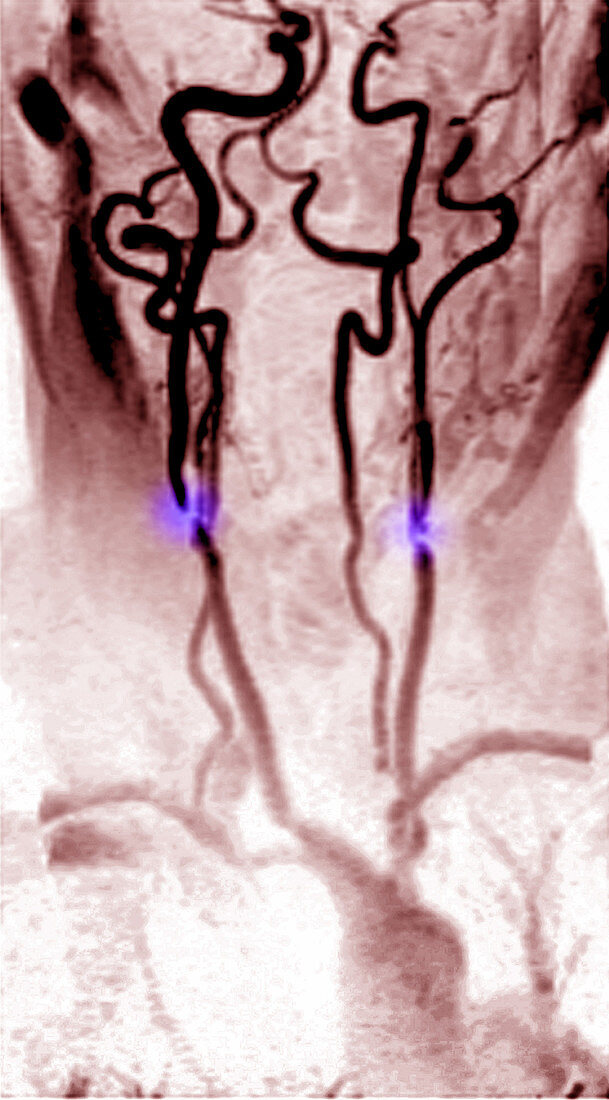 Stenosis of the Internal Carotid Arteries