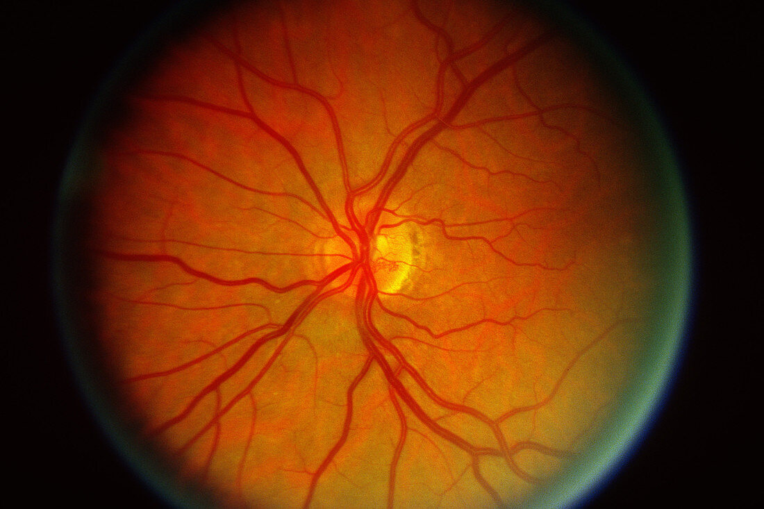 Diabetic Retinopathy