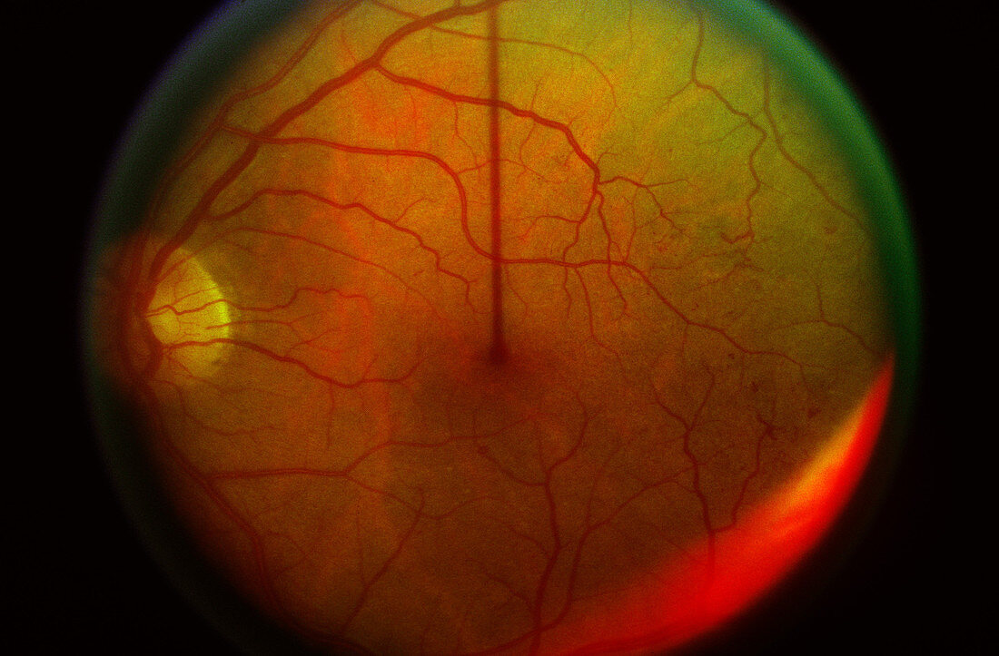 Diabetic Retinopathy